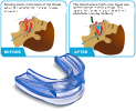 gutiere bruxism